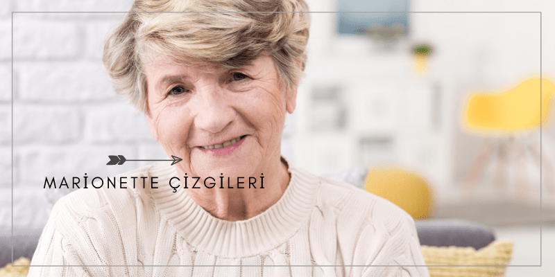 Marionette Çizgileri Nedir ve Nasıl Geçer?