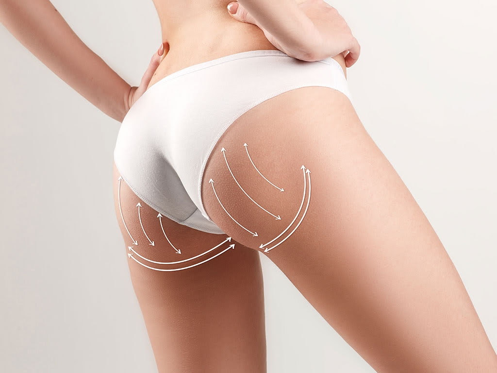 Brazilian Butt Lift (BBL)